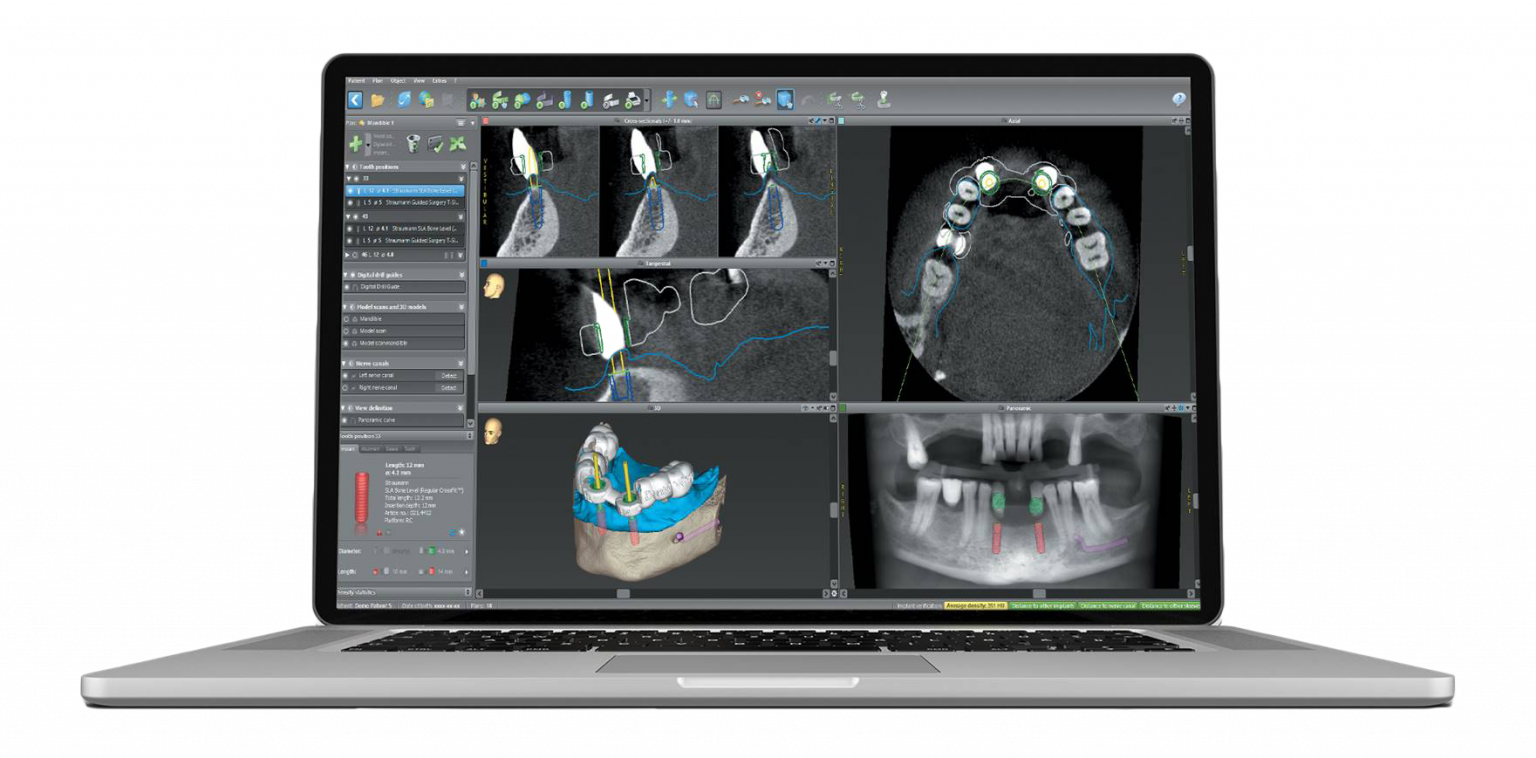 Digital Workflow For Full Arch To Single Implant Treatment: Enhancing ...