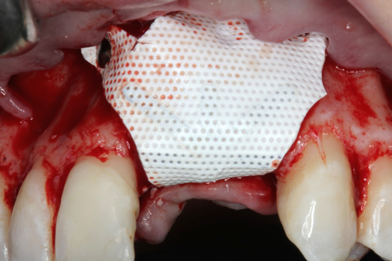 non resorb membrane